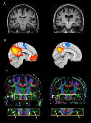 Frontiers | The Influence Of Genetic Factors And Cognitive Reserve On ...